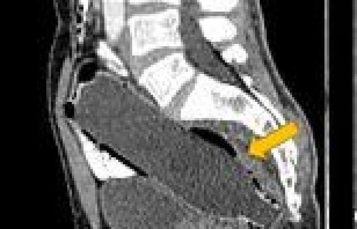 50 வயது நபரின் ஆசன வாய் பகுதியில் சிக்கிய வாட்டர் பாட்டில்.. நடந்தவற்றை கேட்டு மருத்துவர்கள் அதிர்ச்சி!