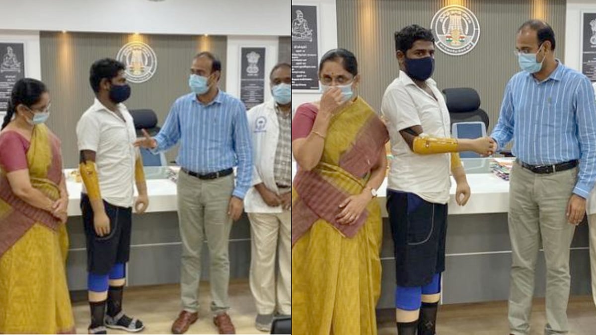 செயற்கை கை கால்களை பொருத்திய கோவை அரசு மருத்துவமனை.. முதல்வர் காப்பீடு திட்டத்தின் கீழ் சாதனை !