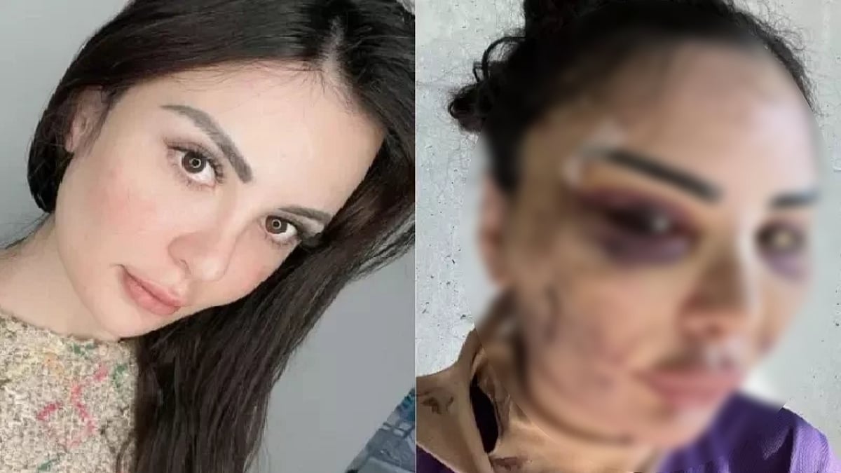 40 முறை அறுவை சிகிச்சை.. அமெரிக்க மாடல் அழகி போல் மாற நினைத்த இளம்பெண்ணுக்கு நேர்ந்த அவலம் !