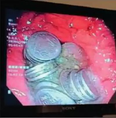 இப்படியும் நடக்குமா? : வயிற்று வலி.. வாலிபருக்கு அறுவை சிகிச்சை செய்தபோது அதிர்ந்து போன டாக்டர்கள் !