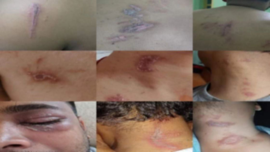 கடுமையான  நோய்த்தொற்று - மாணவர்களை தாக்கிய ’நைரோபி ஃப்ளைஸ்’ பூச்சி.. சிக்கிமில் நடந்த அதிர்ச்சி சம்பவம்!