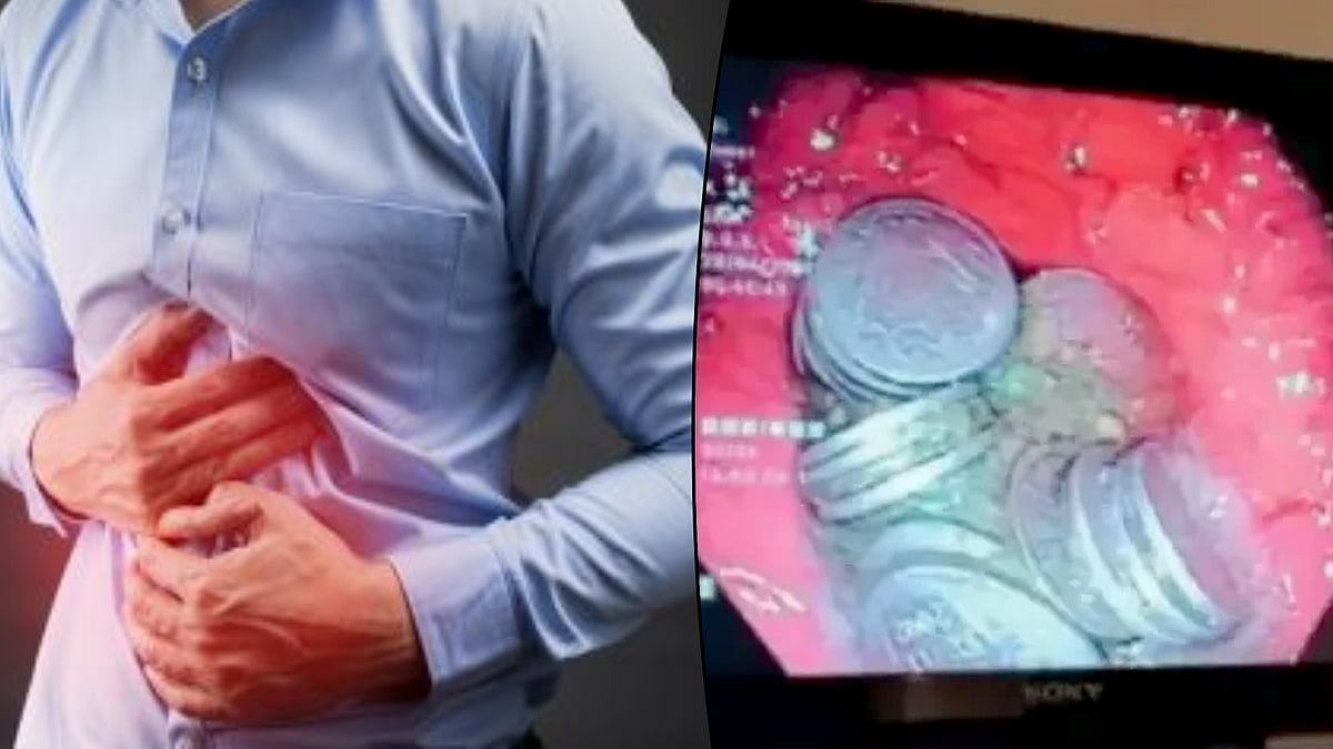 63 நாணயங்களை சாப்பிட்ட இளைஞர்.. நாணயங்களை சாப்பிட்ட காரணத்தை கேட்டு அதிர்ந்த மருத்துவர்கள் !