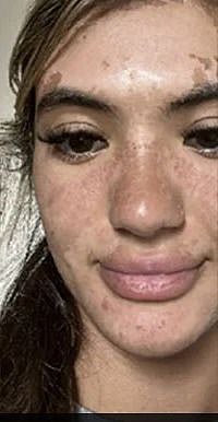 "வெயில்ல படுத்து தூங்குனா இப்படிலாம் நடக்குமா?.." PLASTIC போல் உரிந்த இளம்பெண்ணின் நெற்றி !