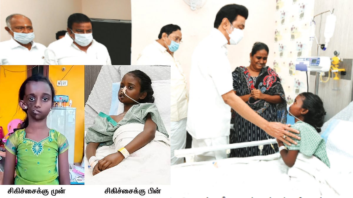 "operation முடிஞ்சிருச்சு.. சீக்கிரமா school போகலாம்" -அறுவை சிகிச்சை முடிந்த சிறுமியிடம் முதல்வர் !