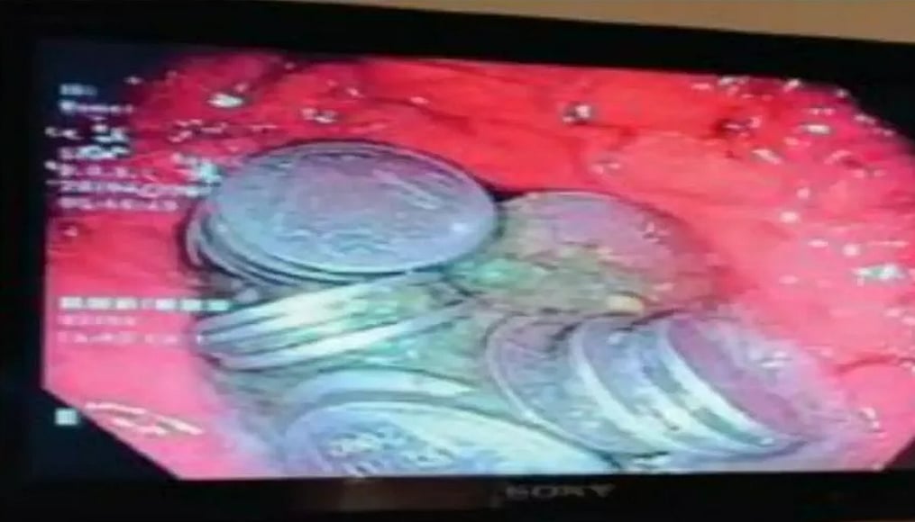 63 நாணயங்களை சாப்பிட்ட இளைஞர்.. நாணயங்களை சாப்பிட்ட காரணத்தை கேட்டு அதிர்ந்த மருத்துவர்கள் !