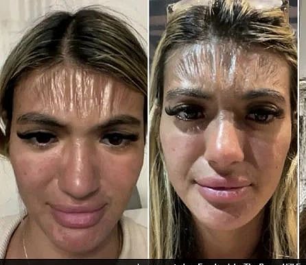 "வெயில்ல படுத்து தூங்குனா இப்படிலாம் நடக்குமா?.." PLASTIC போல் உரிந்த இளம்பெண்ணின் நெற்றி !