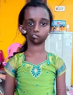 அரிய நோயால் பாதிக்கப்பட்ட திருவள்ளூர் சிறுமி..  உயர்தர சிகிச்சை அளிக்க நடவடிக்கை எடுத்த தமிழ்நாடு அரசு!