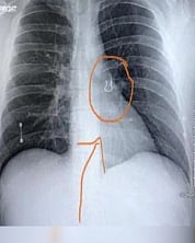 5 வருடத்துக்கு முன் தொலைத்த மூக்குத்தி.. நுரையீரலில் கண்டுபிடிக்கப்பட்ட ஆச்சரியம் !