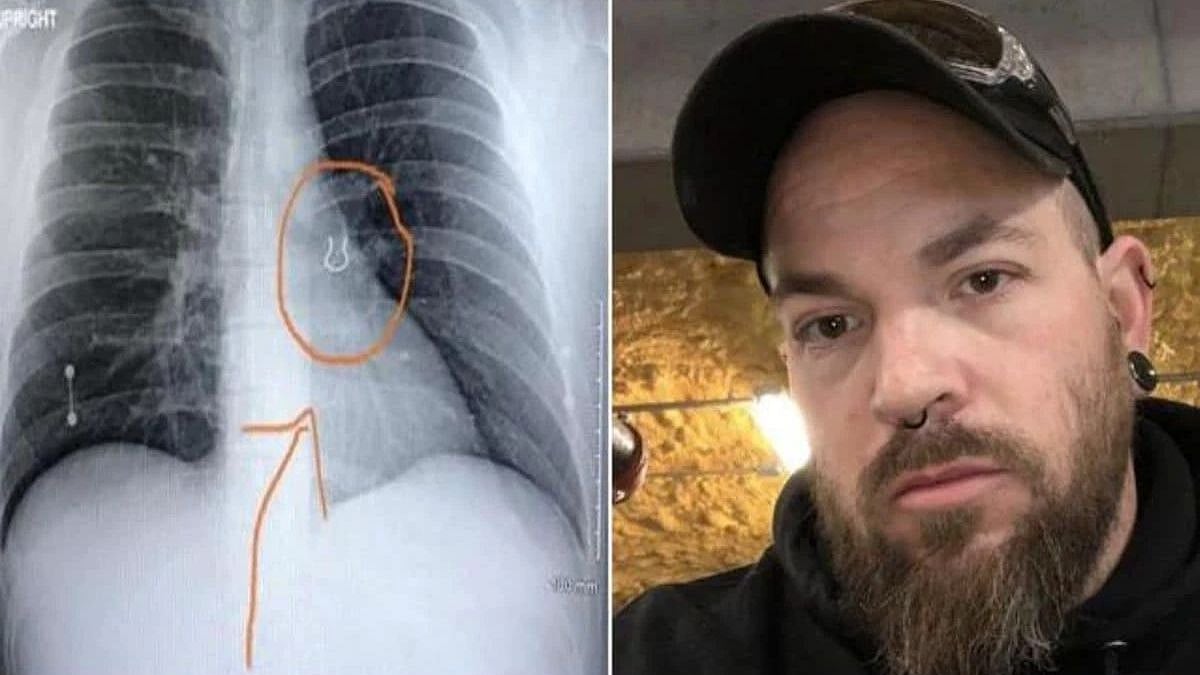 5 வருடத்துக்கு முன் தொலைத்த மூக்குத்தி.. நுரையீரலில் கண்டுபிடிக்கப்பட்ட ஆச்சரியம் ! 