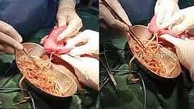 சிறுவனின் குடலில் 1 கிலோ புழுக்கள்.. வயிற்று வலி வந்தால் கவனம் வேண்டும் என  மருத்துவர்கள் எச்சரிக்கை ! 