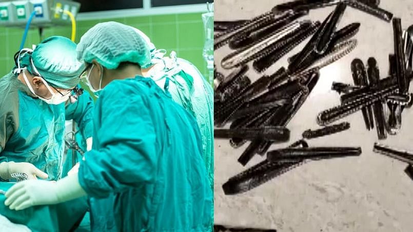 உணவுக்கு பதில் ஸ்பூன் சாப்பிட்டு வந்த இளைஞர்.. வயிற்றில் இருந்த 62 ஸ்பூன்கள்: மருத்துவர்கள் அதிர்ச்சி!