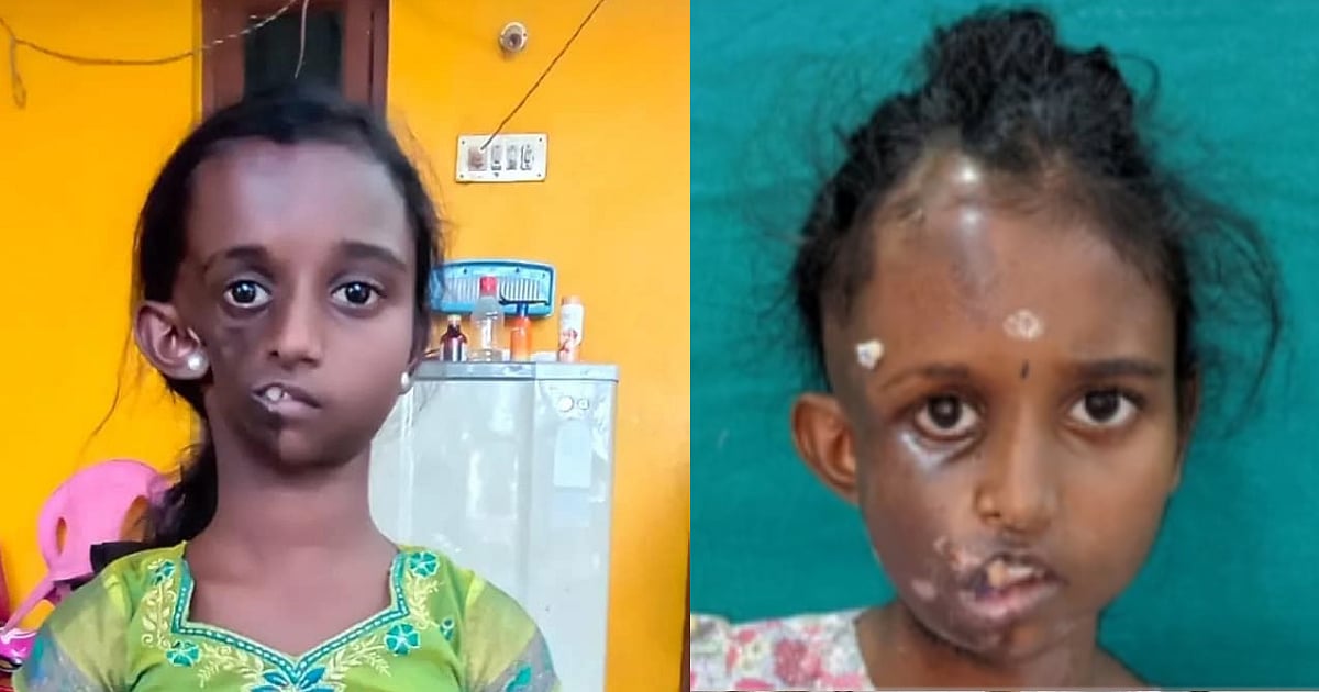 சிகிச்சைக்குப் பிறகு எப்படி இருக்கிறார் சிறுமி தான்யா? : அதிகாரப்பூர்வ புகைப்படம் வெளியீடு !