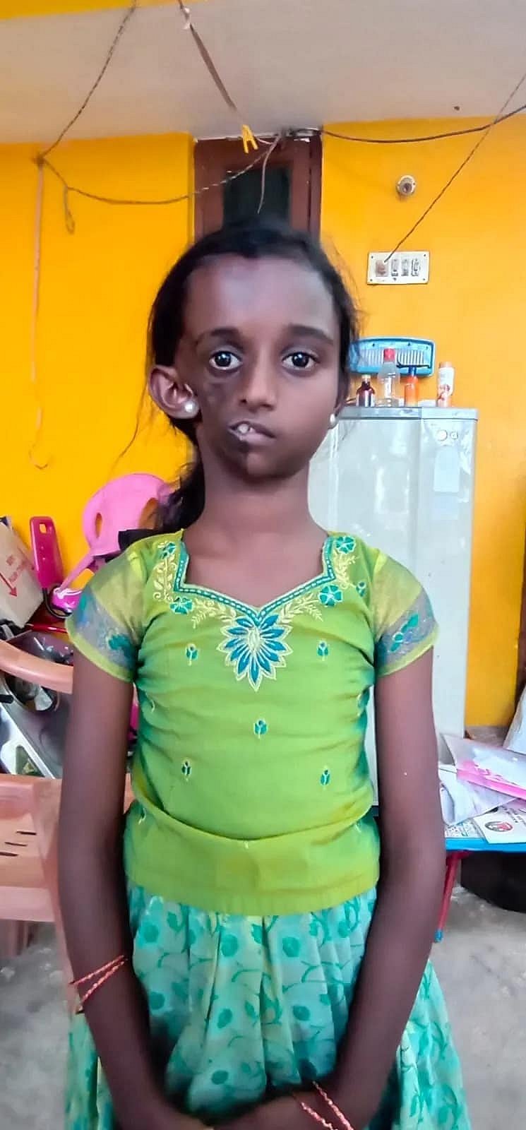 சிகிச்சைக்குப் பிறகு எப்படி இருக்கிறார் சிறுமி தான்யா? : அதிகாரப்பூர்வ புகைப்படம் வெளியீடு !