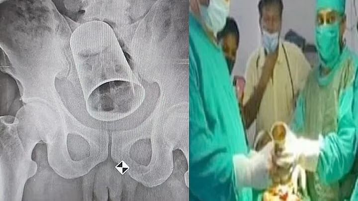 காற்றடிக்கும் கருவியால் வந்த வினை.. நண்பன் செய்த செயலால் பறிபோன சக நண்பனின் உயிர் : ம.பி-யில் அதிர்ச்சி !