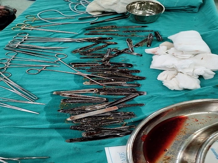 உணவுக்கு பதில் ஸ்பூன் சாப்பிட்டு வந்த இளைஞர்.. வயிற்றில் இருந்த 62 ஸ்பூன்கள்: மருத்துவர்கள் அதிர்ச்சி!