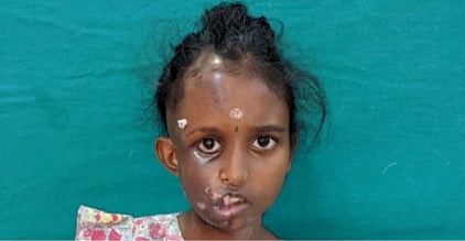 சிகிச்சைக்குப் பிறகு எப்படி இருக்கிறார் சிறுமி தான்யா? : அதிகாரப்பூர்வ புகைப்படம் வெளியீடு !