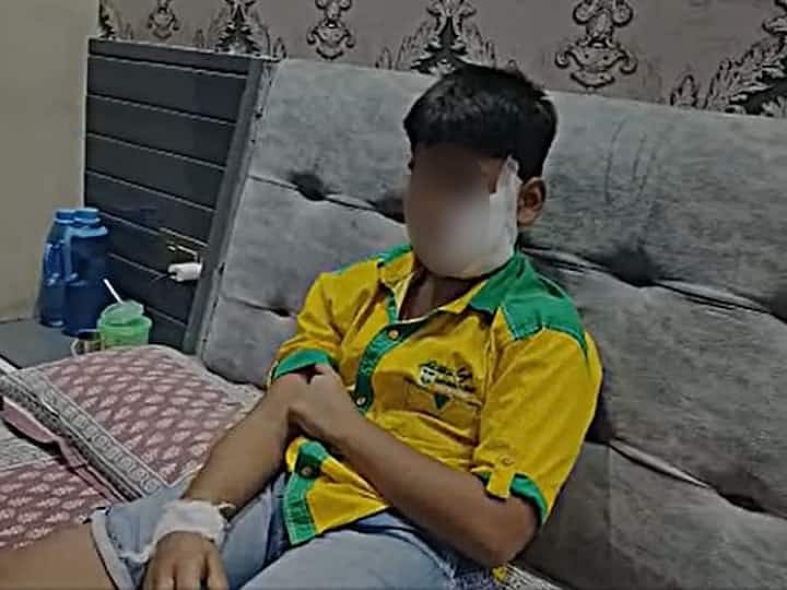 முகத்தில் மட்டும் 150 தையல்கள்.. பூங்காவில் விளையாடிய சிறுவனை கடித்து குதறிய பிட்புல் நாய் !