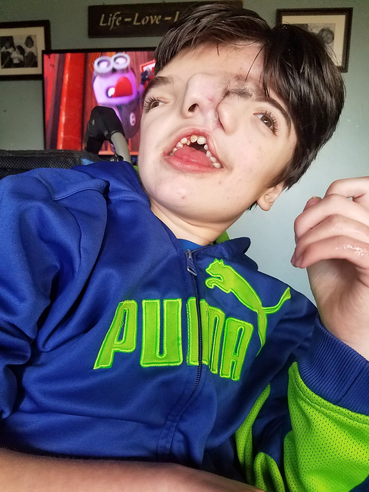 "உங்கள் மகன் பிழைக்க மாட்டான்.." - மருத்துவர்கள் கூறியதை பொய்யாக்கிய இரண்டு தலை கொண்ட அரிய சிறுவன்..