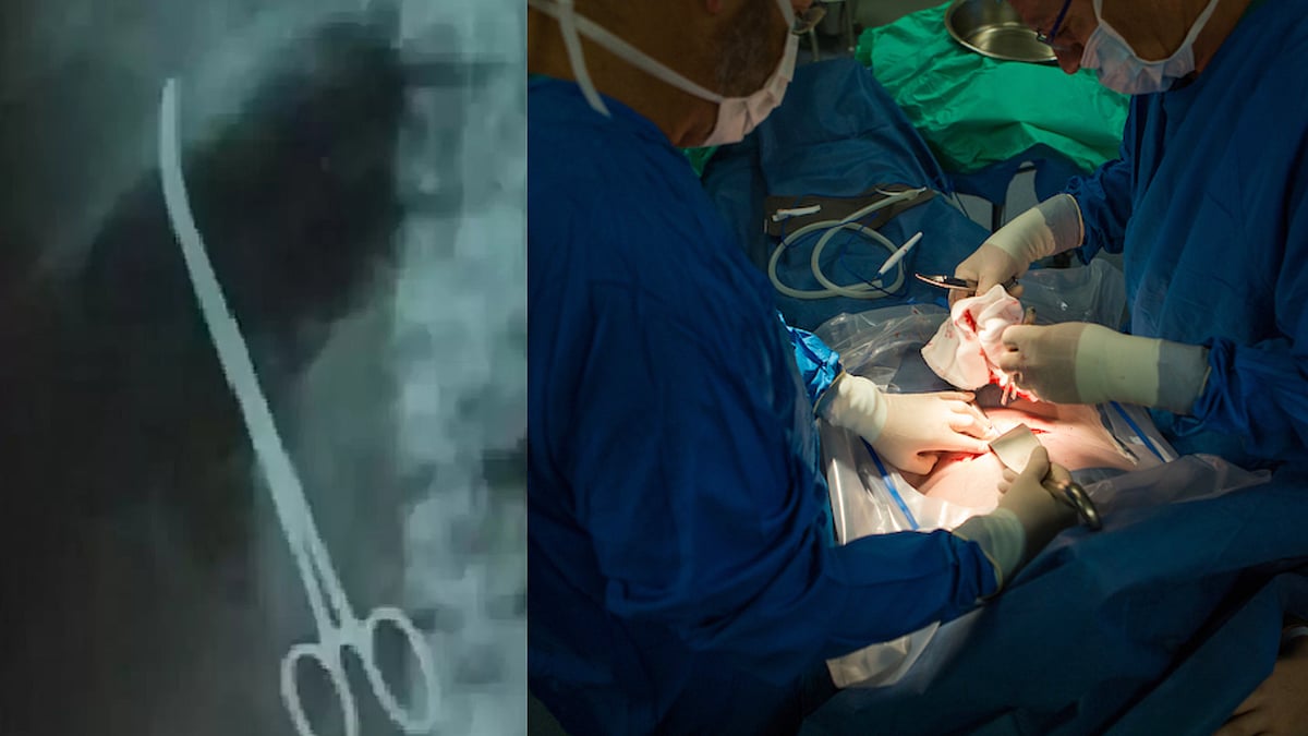 இளம்பெண் வயிற்றுக்குள் 5 வருடமாக இருந்த கத்தரிக்கோல்.. பிரசவத்தின் போது நடந்த சோகம்.. கேரளாவில் அதிர்ச்சி