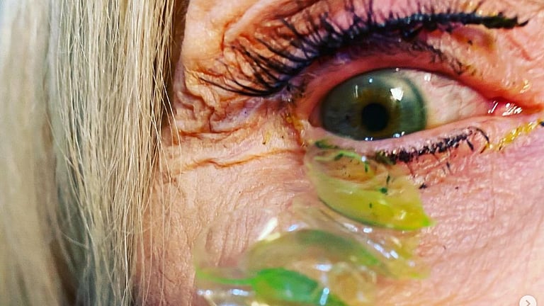 கண்களில் இருந்து அகற்றப்பட்ட 23 contact lenses..தூங்கும்போது கழட்ட மறந்ததால் சோகம்..வைரலாகும் வீடியோ!