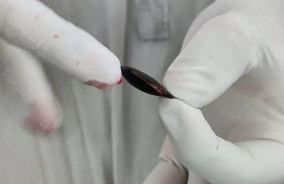 2 மாதங்களாக நுரையீரலில் சிக்கியிருந்த சப்போட்டா விதை.. அறுவை சிகிச்சை மூலம் அகற்றிய அரசு மருத்துவர்கள் !