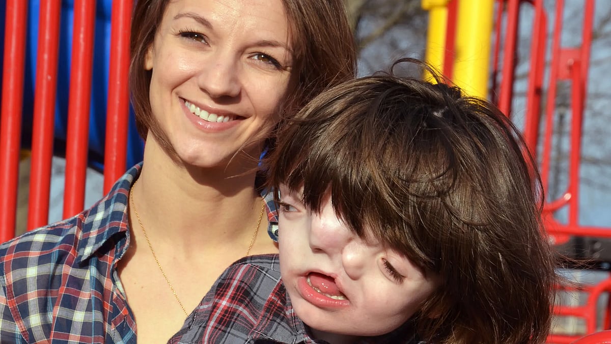 "உங்கள் மகன் பிழைக்க மாட்டான்.." - மருத்துவர்கள் கூறியதை பொய்யாக்கிய இரண்டு தலை கொண்ட அரிய சிறுவன்..