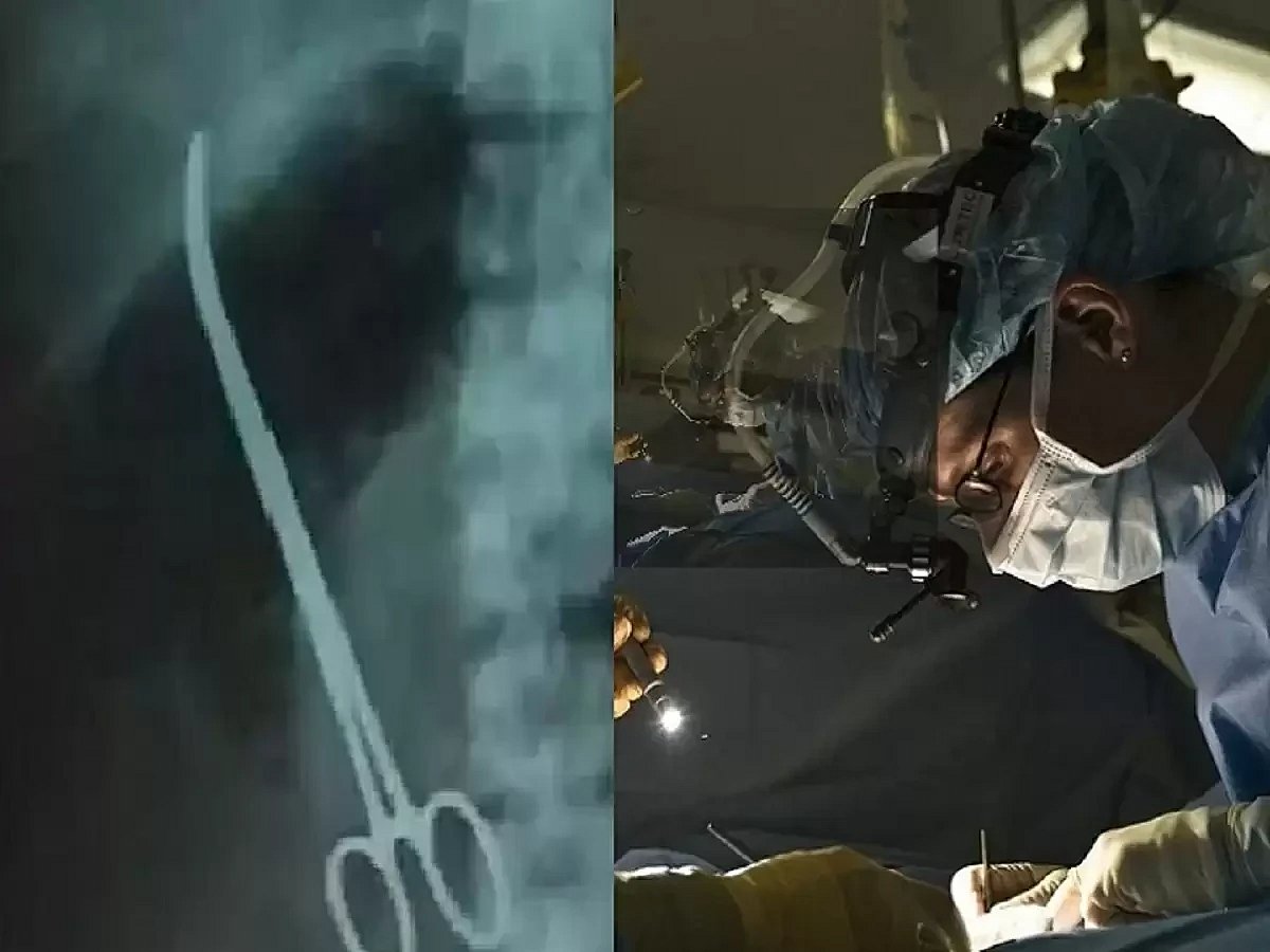 இளம்பெண் வயிற்றுக்குள் 5 வருடமாக இருந்த கத்தரிக்கோல்.. பிரசவத்தின் போது நடந்த சோகம்.. கேரளாவில் அதிர்ச்சி