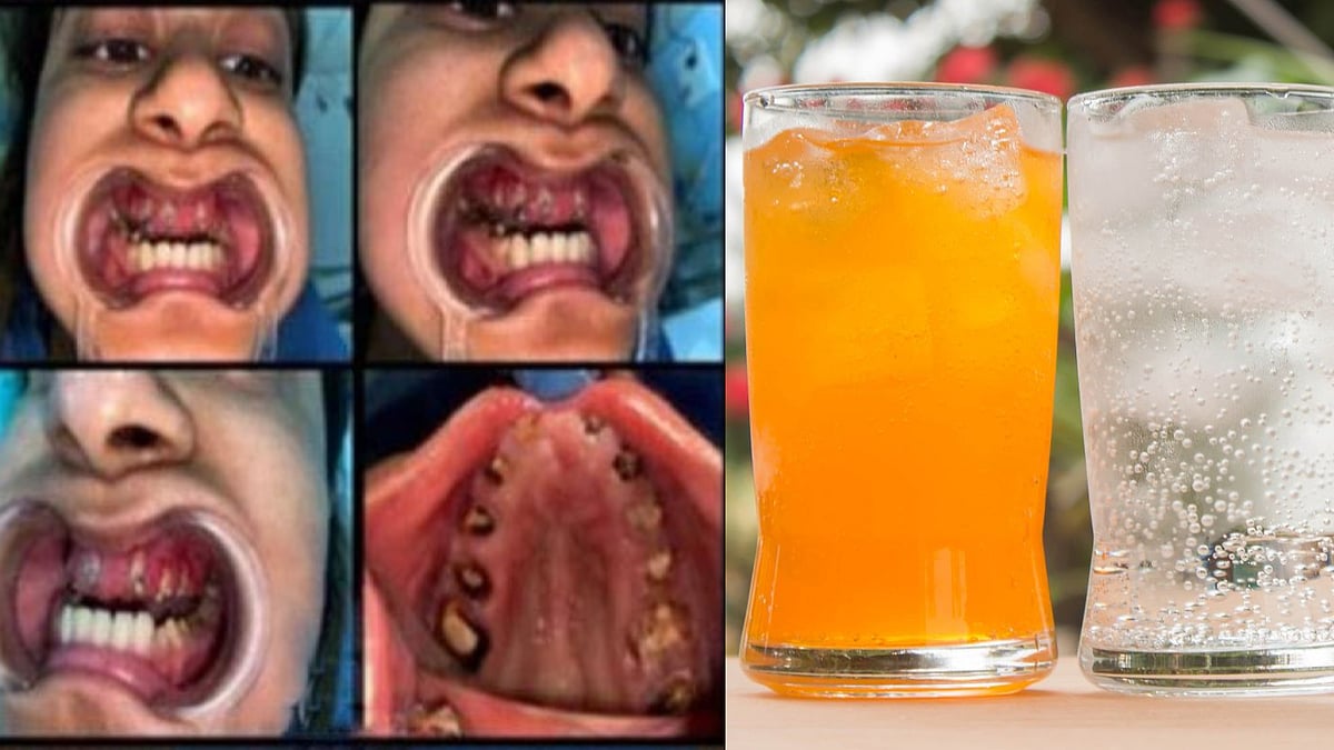 சொத்தையான பற்கள்.. அதிக அளவில் குளிர்பானங்களை குடித்த பெண்ணுக்கு நேர்ந்த சோகம்..மருத்துவர்கள் எச்சரிக்கை!