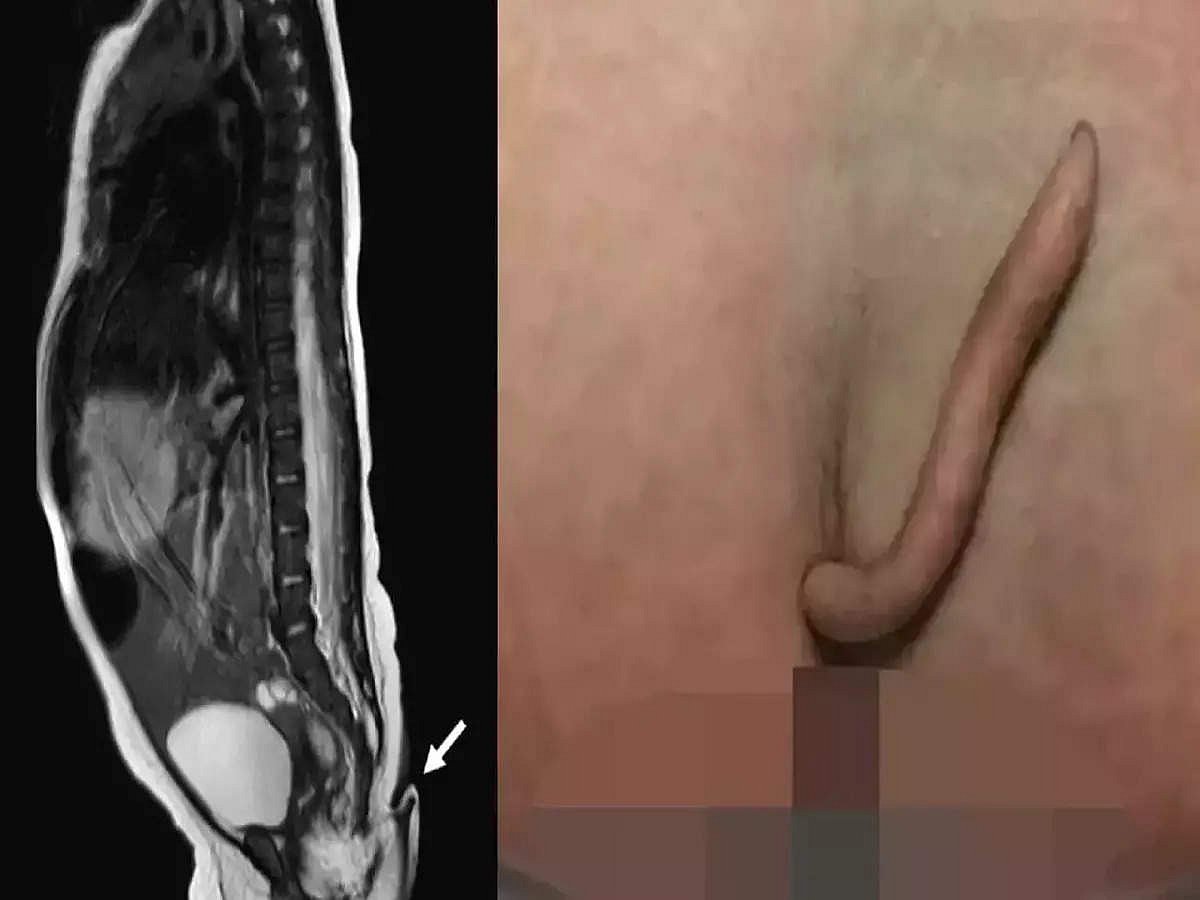 “உண்மையான வாலுடன் பிறந்த பெண் குழந்தையா..!” - அதிசய நிகழ்வு குறித்து மருத்துவர் அளிக்கும் விளக்கம் என்ன ?