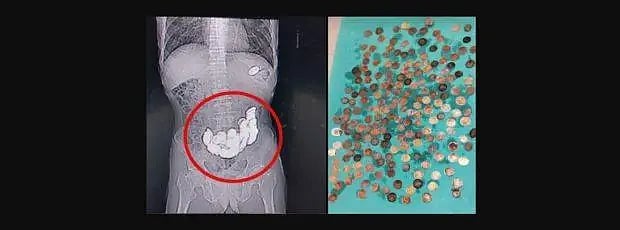 முதியவரின் வயிற்றில் 187 நாணயங்கள்.. ஒன்றரை கிலோ எடை இருந்ததால் மருத்துவர்கள் அதிர்ச்சி ! 