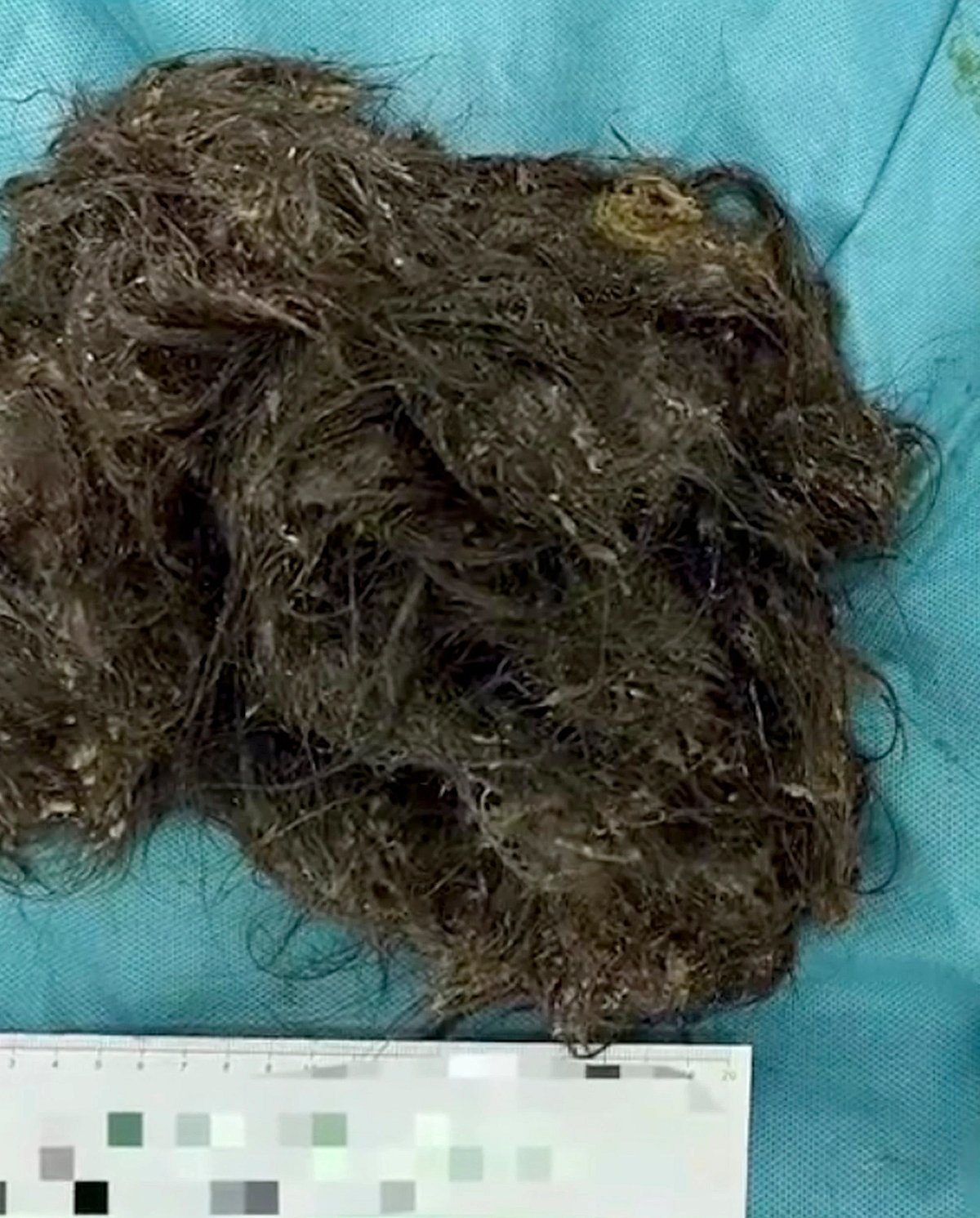 “சாப்பாட்டுக்கு கூட வயிற்றில் இடமில்லை..” -உணவு குழாயை அடைத்த 3 கிலோ முடி: சிறுமிக்கு ஏற்பட்ட விநோத நோய்!