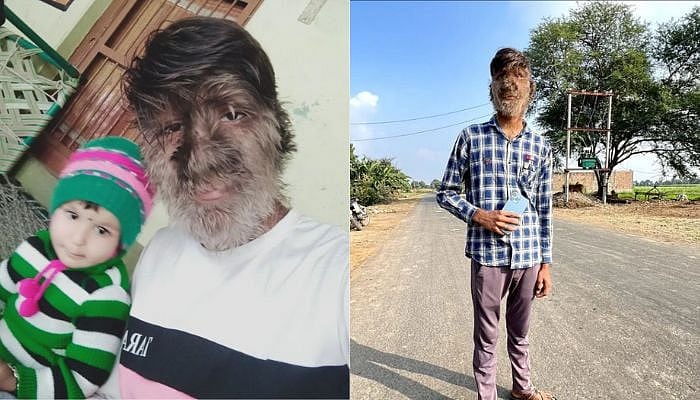 முகம் முழுவதும் முடி வளரும் விநோத நோய்.. 'குரங்கு மனிதர்' என பிறர் கிண்டல் செய்வதாக இளைஞர் வேதனை !