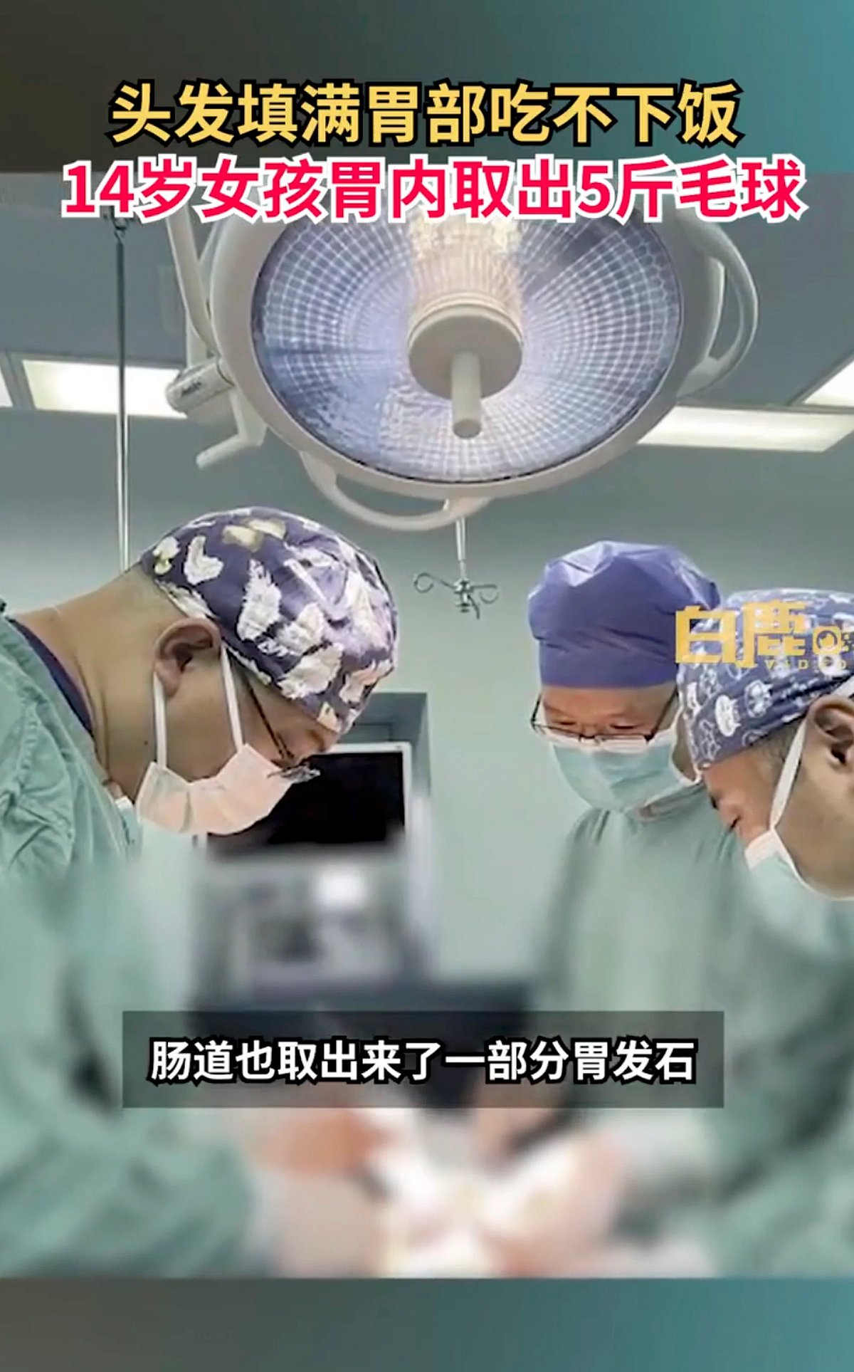 “சாப்பாட்டுக்கு கூட வயிற்றில் இடமில்லை..” -உணவு குழாயை அடைத்த 3 கிலோ முடி: சிறுமிக்கு ஏற்பட்ட விநோத நோய்!