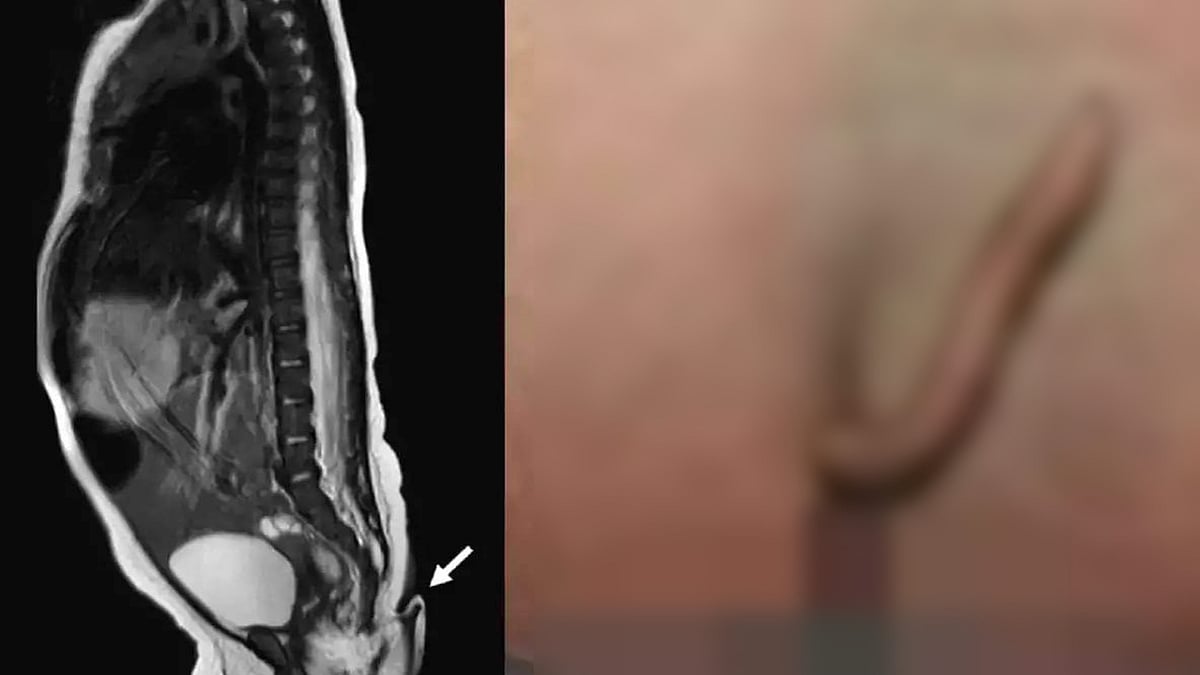 “உண்மையான வாலுடன் பிறந்த பெண் குழந்தையா..!” - அதிசய நிகழ்வு குறித்து மருத்துவர் அளிக்கும் விளக்கம் என்ன ?