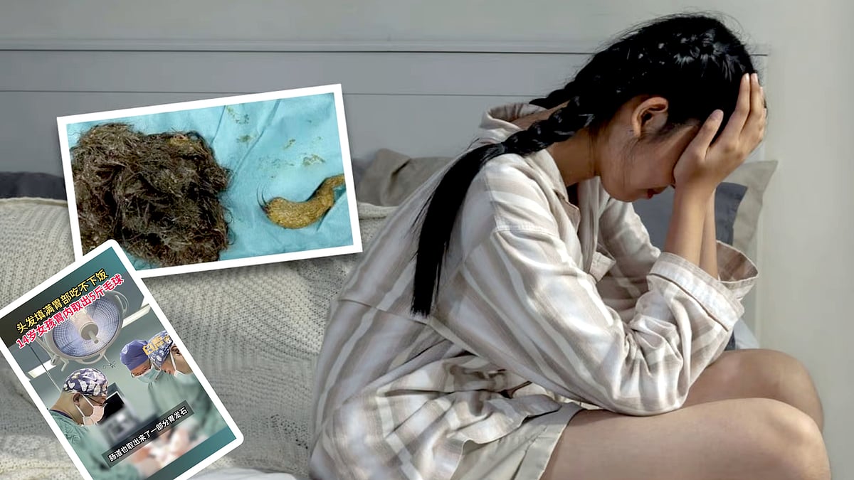 “சாப்பாட்டுக்கு கூட வயிற்றில் இடமில்லை..” -உணவு குழாயை அடைத்த 3 கிலோ முடி: சிறுமிக்கு ஏற்பட்ட விநோத நோய்!