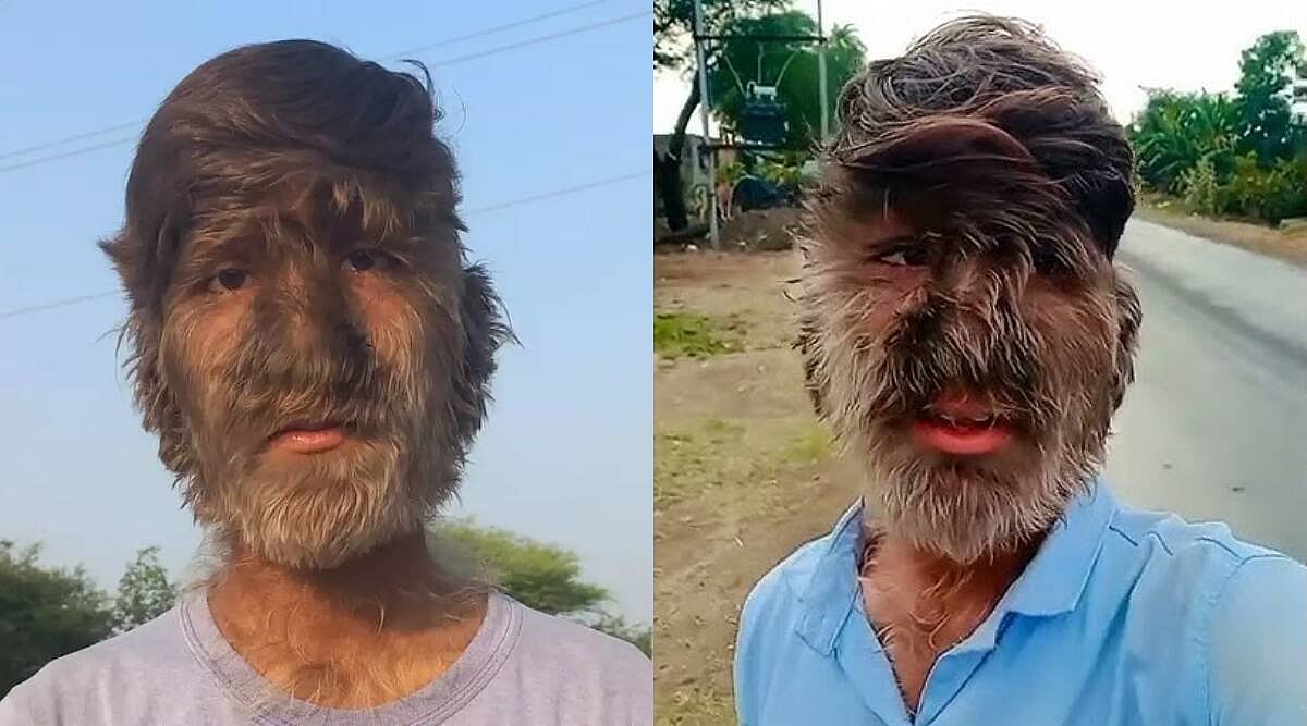 முகம் முழுவதும் முடி வளரும் விநோத நோய்.. 'குரங்கு மனிதர்' என பிறர் கிண்டல் செய்வதாக இளைஞர் வேதனை !