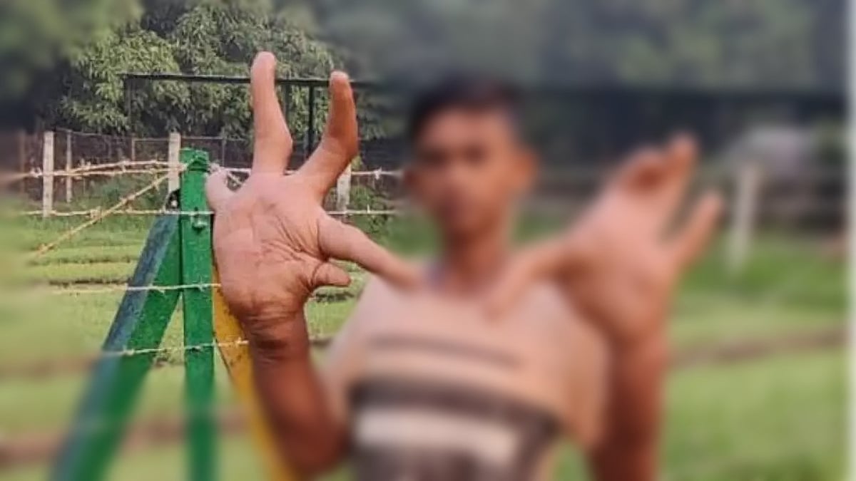 Hulk Hand.. 2 கையும் 8 கிலோ: அரியவகை நோயால் பாதித்த 16 வயது சிறுவனை ஒதுக்கிவைத்த கிராமம்!