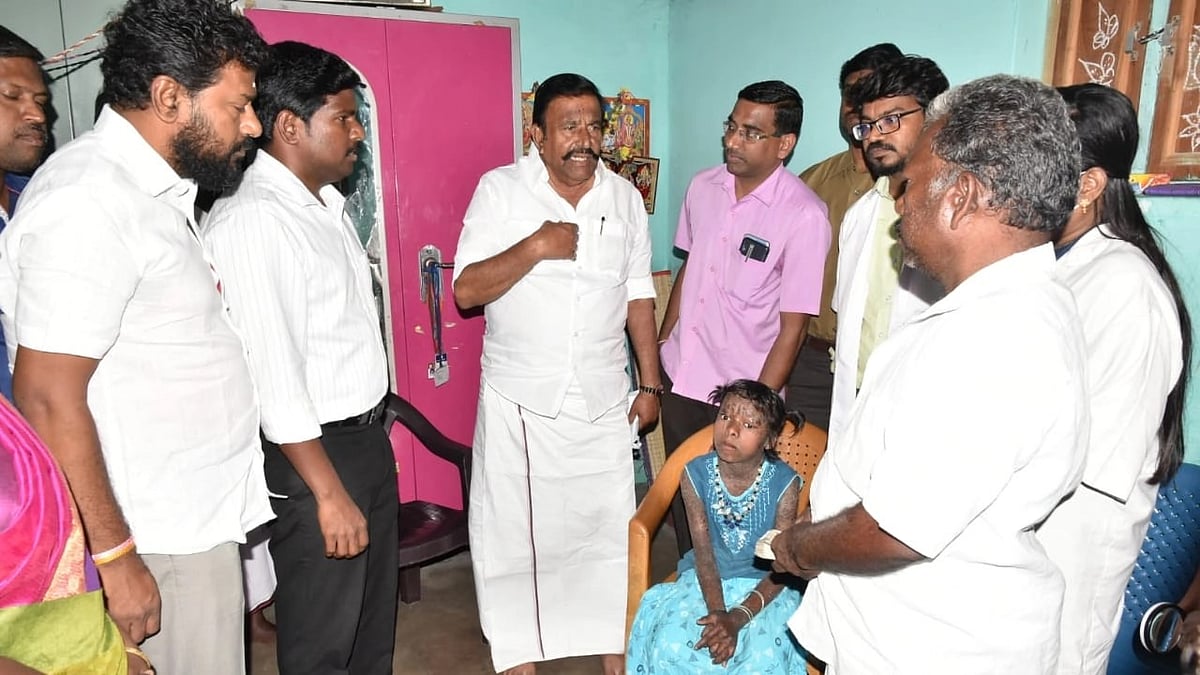 அரியவகை தோல் நோயால் பாதிக்கப்பட்ட சிறுமி.. வறுமையில் உழன்ற குடும்பத்திற்கு உதவிக்கரம் நீட்டிய அமைச்சர் !