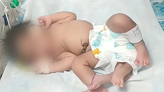 4 கால்களுடன் பிறந்த அதிசய பெண் குழந்தை.. மருத்துவர்கள் கூறும் காரணம் என்ன?