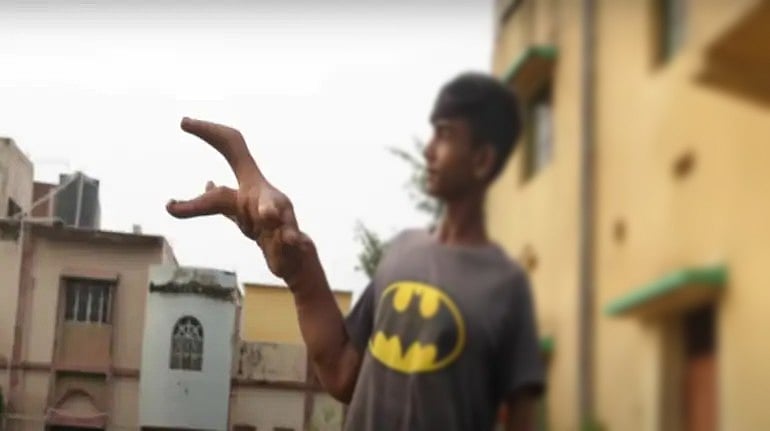 Hulk Hand.. 2 கையும் 8 கிலோ: அரியவகை நோயால் பாதித்த 16 வயது சிறுவனை ஒதுக்கிவைத்த கிராமம்!