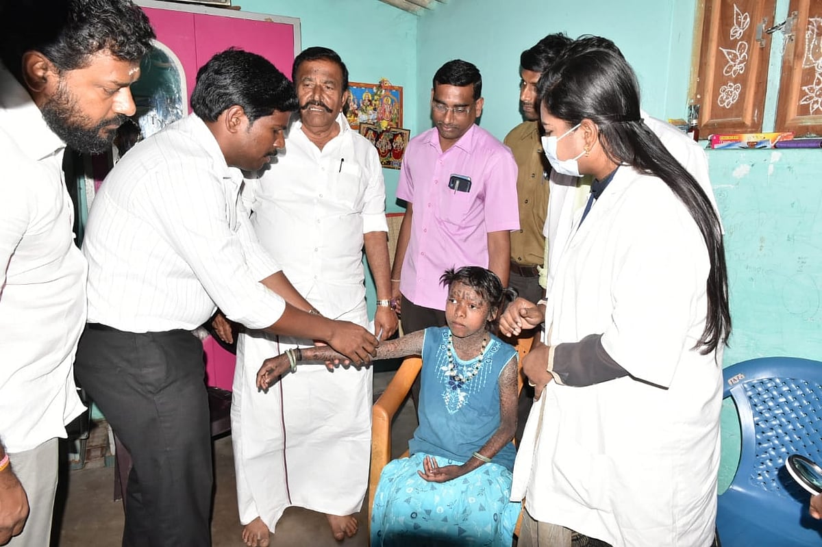 அரியவகை தோல் நோயால் பாதிக்கப்பட்ட சிறுமி.. வறுமையில் உழன்ற குடும்பத்திற்கு உதவிக்கரம் நீட்டிய அமைச்சர் !