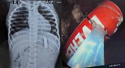 TV Remote பேட்டரியை விழுங்கிய 2 வயது சிறுவன்.. 20 நிமிடத்தில் உயிரைக் காப்பாற்றிய மருத்துவர்கள்!