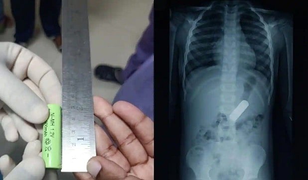 TV Remote பேட்டரியை விழுங்கிய 2 வயது சிறுவன்.. 20 நிமிடத்தில் உயிரைக் காப்பாற்றிய மருத்துவர்கள்!