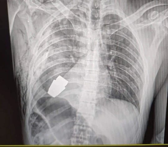 உக்ரைன் வீரரின் உடலுக்குள் வெடிக்கும் தருவாயில் இருந்த Grenade Bomb.. உயிரை பணயம் காப்பாற்றிய மருத்துவர்!