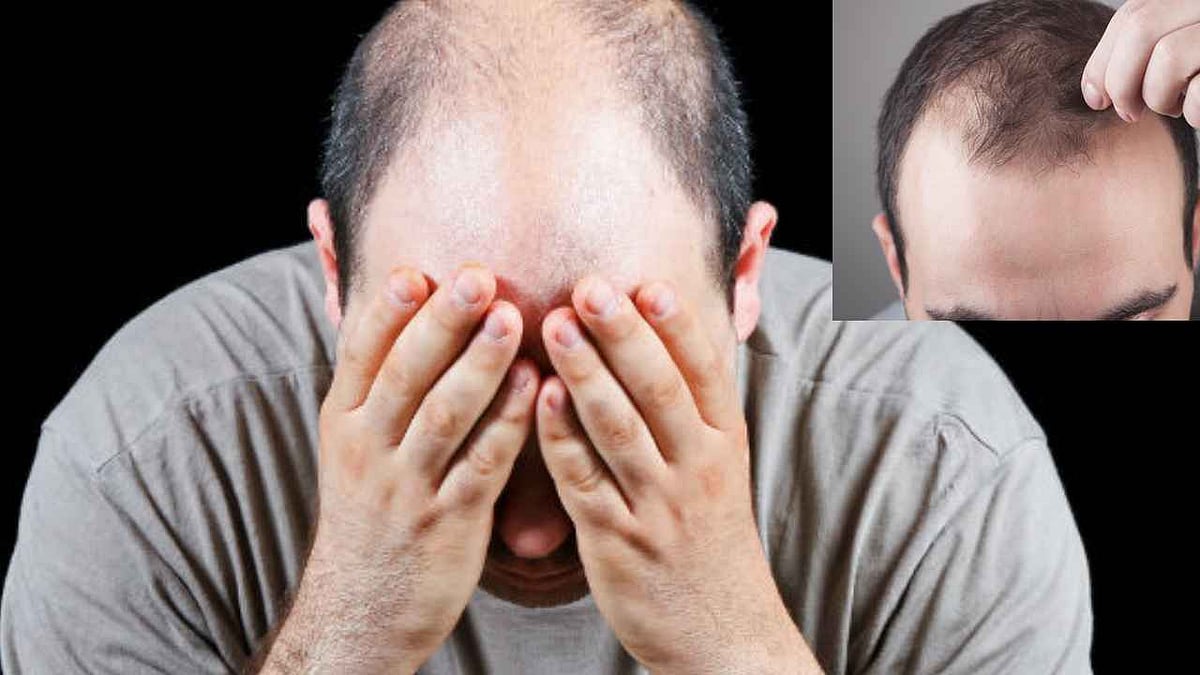 “வழுக்கையுடன் இருப்பவர்களுக்கு ரூ.6000 ஓய்வூதியம் வேண்டும்..” - புதிதாக சங்கம் உருவாக்கி கோரிக்கை !