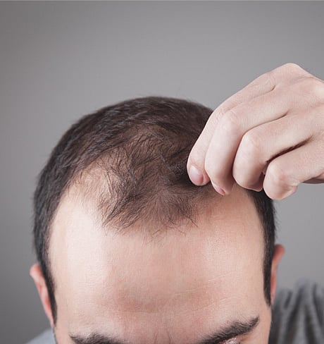 “வழுக்கையுடன் இருப்பவர்களுக்கு ரூ.6000 ஓய்வூதியம் வேண்டும்..” - புதிதாக சங்கம் உருவாக்கி கோரிக்கை !