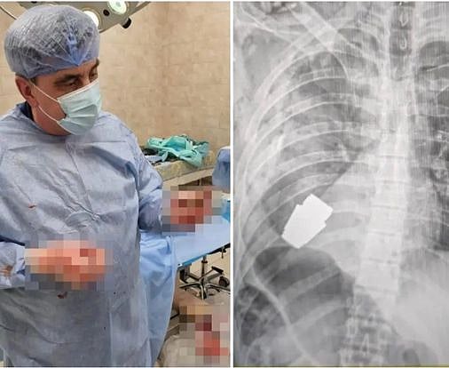 உக்ரைன் வீரரின் உடலுக்குள் வெடிக்கும் தருவாயில் இருந்த Grenade Bomb.. உயிரை பணயம் காப்பாற்றிய மருத்துவர்!