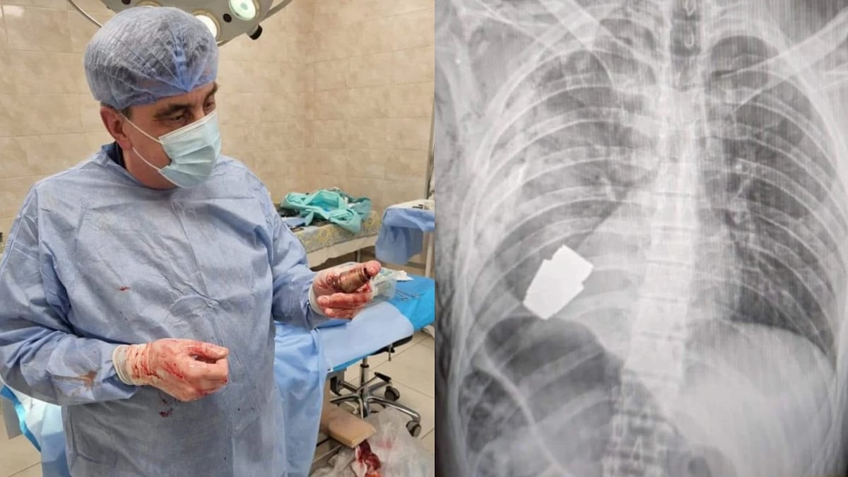 உக்ரைன் வீரரின் உடலுக்குள் வெடிக்கும் தருவாயில் இருந்த Grenade Bomb.. உயிரை பணயம் காப்பாற்றிய மருத்துவர்!