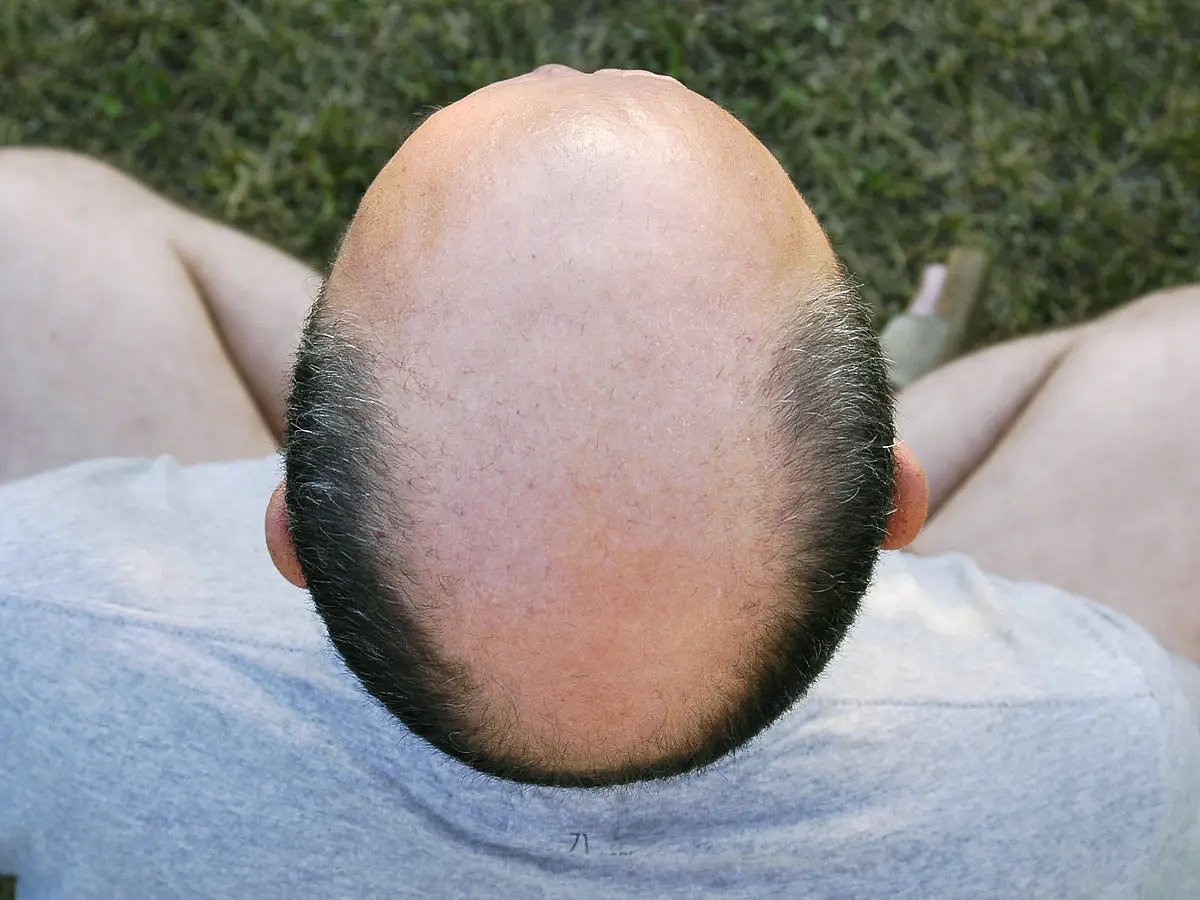 “எங்க டீம்ல வழுக்கை தலை உள்ள ஆள் வேண்டாம்..” வேலையை விட்டு நீக்கிய நிறுவனம்.. அதிரடி காட்டிய நீதிமன்றம் !