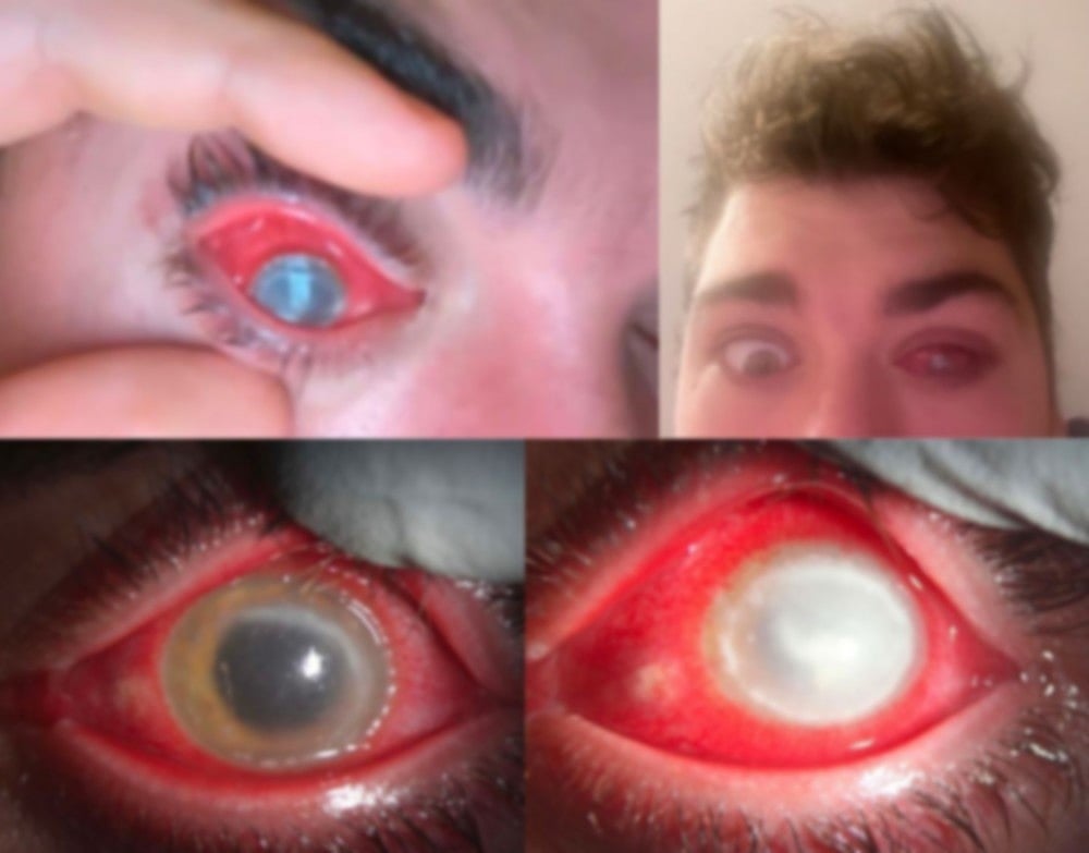 மக்களே உஷார்..! Lens போட்டு தூங்கிய நபர்.. திடீரென காணாமல் போன கருவிழி.. அதிர்ச்சியில் இளைஞர் !